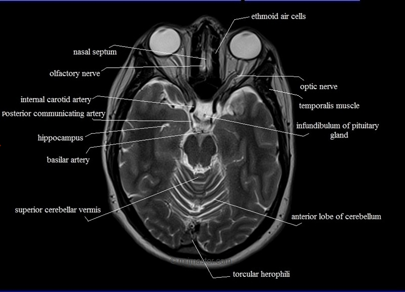MRI master - transverse MRI brain